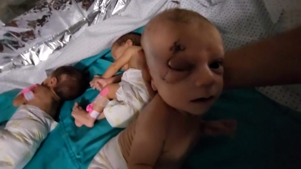 جيش الاحتلال يواصل تحقيق انتصارات على الجرحى والخدج بالمستشفيات