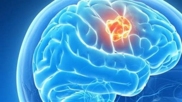 النسيان والسكتة والأمراض العصبية الأبرز.. أضرار التدخين على الدماغ