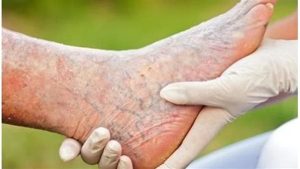 3 أكلات غير متوقعة تعالج دوالى القدمين