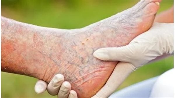 3 أكلات غير متوقعة تعالج دوالى القدمين