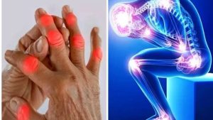 اكتشاف دواء جديد لعلاج آلام المفاصل المزمنة