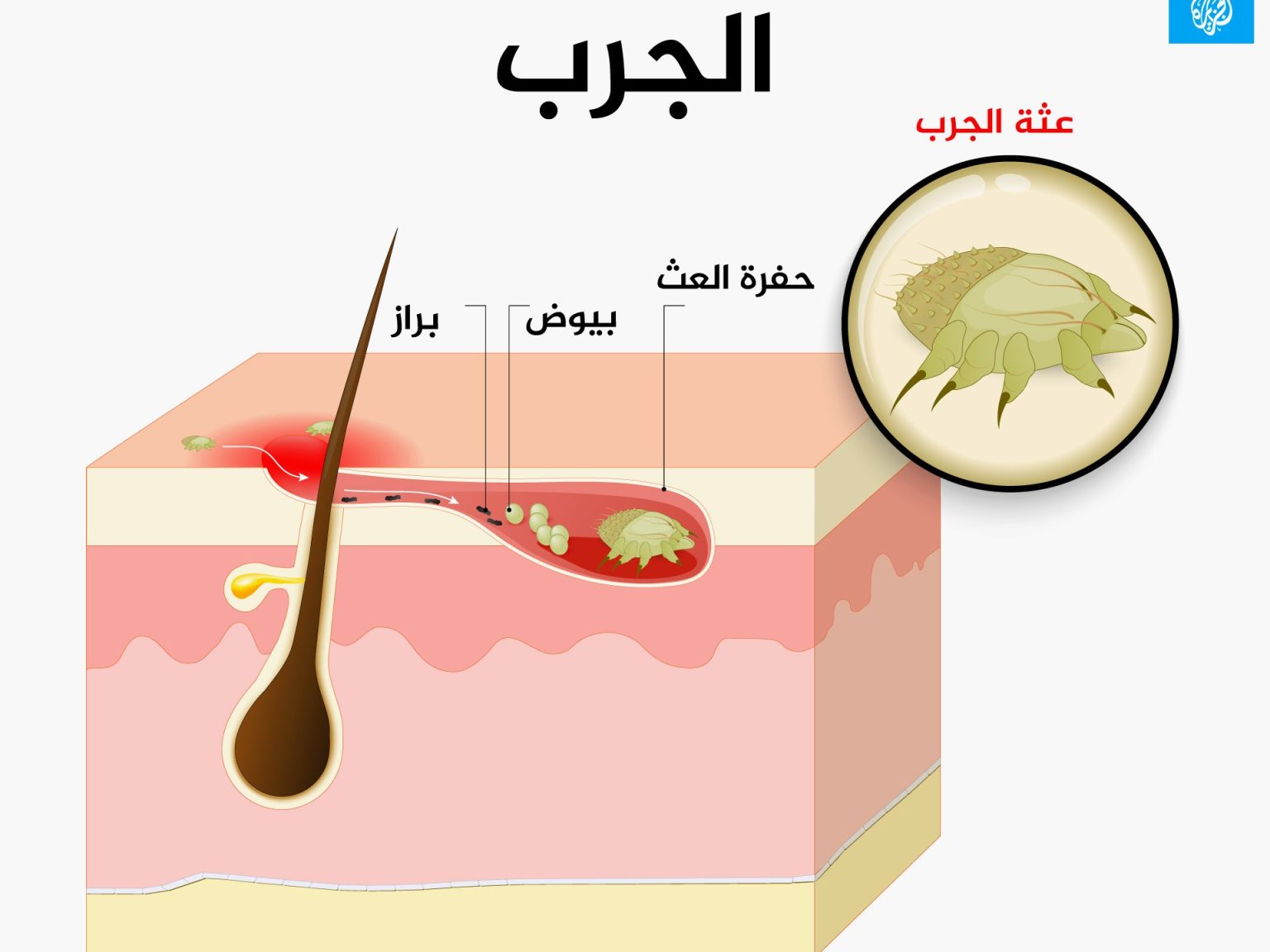 الجرب مرض يشتهر باسم السكابيوس.. الأعراض والعلاج