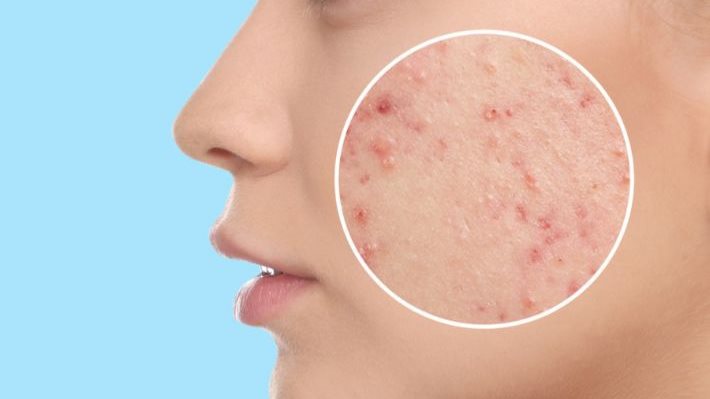 احترس .. هذه الأطعمة تسبّب حب الشباب