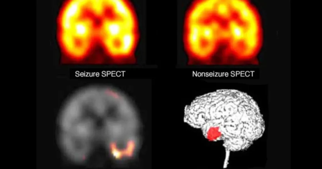 دراسة: مرضى الصرع في إنجلترا لا يحصلون على رعاية متساوية