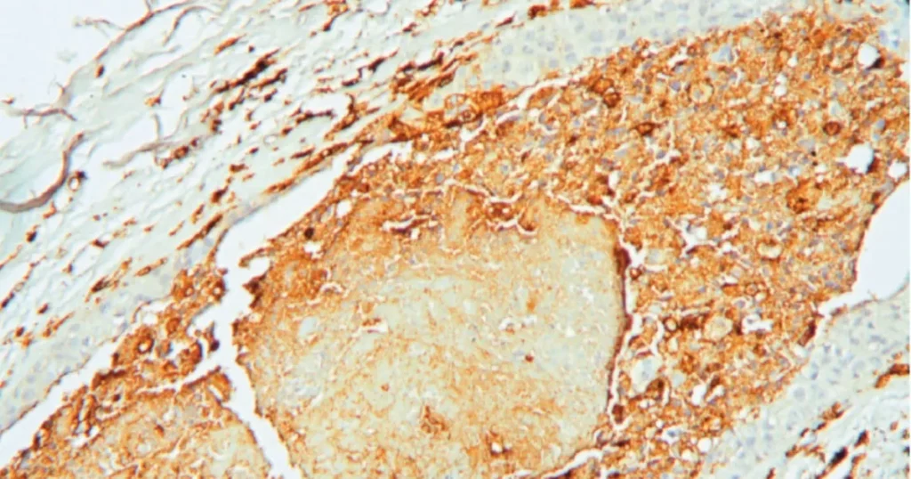 السرطان يربك الساعة البيولوجية للدماغ ويضعف استجابة الجسم