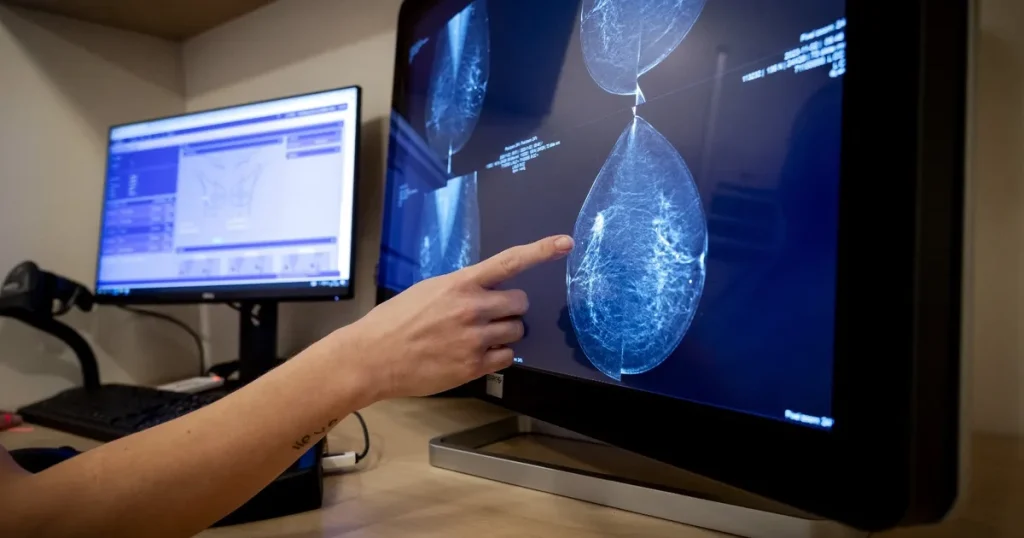 دراسة: “ارتفاع مقلق” في الإصابة بسرطان الثدي بين النساء الأصغر عمراً