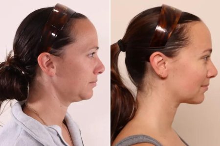 علاج جديد لتجديد البشرة يظهر بعد تراجع وزن مرضى أوزمبيك.